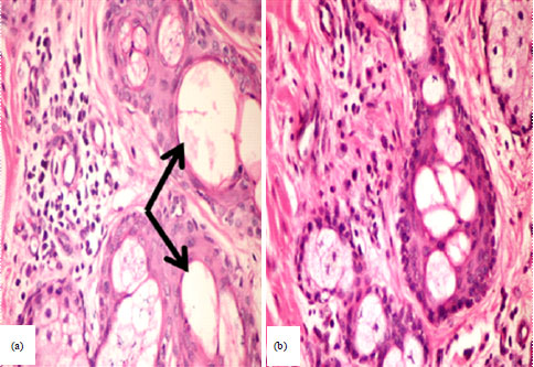 A Gigantic Cutaneous Fibroadenoma In A Dog