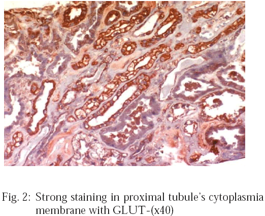 Image for - Is Hif-1α Expression Important in Proliferative and Nonproliferative Glomerulopathy in Terms of Prognosis?
