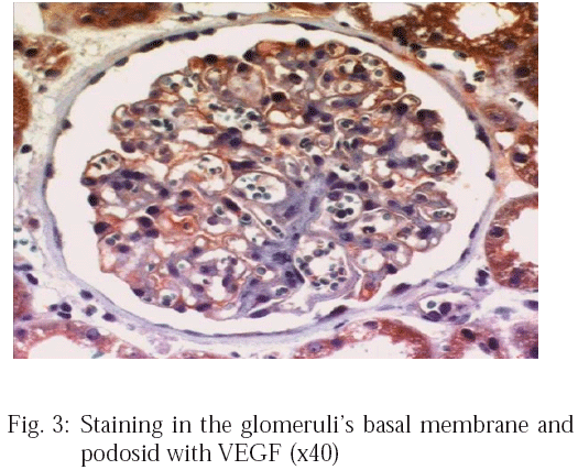 Image for - Is Hif-1α Expression Important in Proliferative and Nonproliferative Glomerulopathy in Terms of Prognosis?