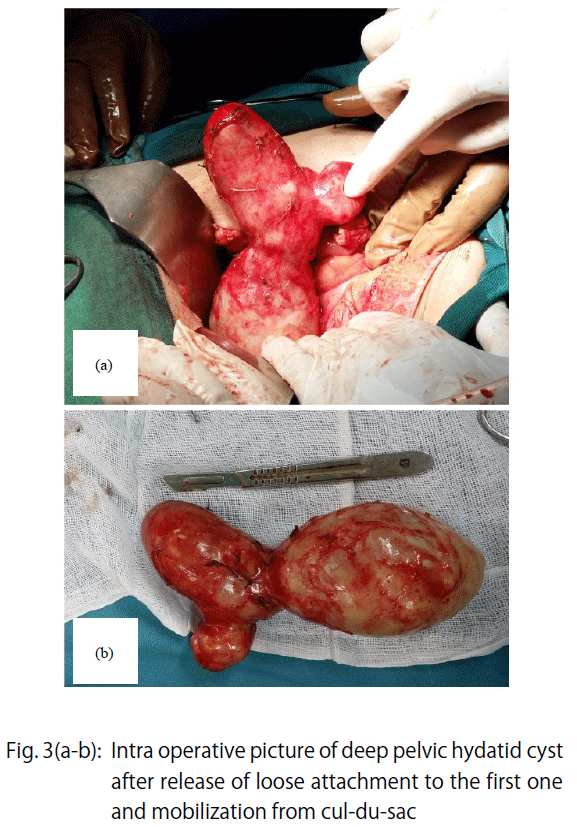 Image for - Primary Pelvic Hydatid Cyst Presenting as an Adnexal Torsion: A Case Report