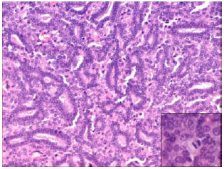 Image for - Histopathology and Immunohistochemical Expression of N-Methyl-N-Nitrosourea (NMU) Induced Mammary Tumours in Sprague-Dawley Rats