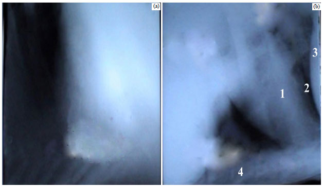 Image for - Laboratory, Radiographic and Ultrasonographic Findings of AcuteTraumatic Reticuloperitonitis in Buffaloes (Bubalus bubalis)