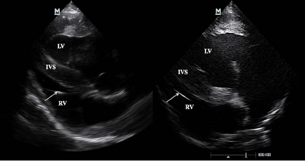 Image for - Pacemaker Implantation in Horse with Bradycardia-Tachycardia Syndrome