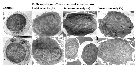 Image for - The Implication of Morphological Characteristics in the Etiology of Allergic Asthma Disease and in Determining the Degree of Severity of Atopic and Bronchial Asthma