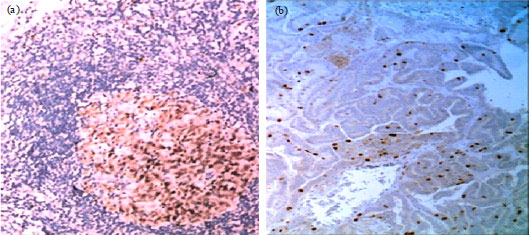 Image for - Correlation of KI-67/MIB-1 in the Papillary Macro and Micro-carcinomas of the Thyroid Gland with the Prognosis of the Patients