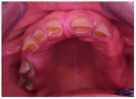 Image for - Overdenture Applications: Two Cases Reports