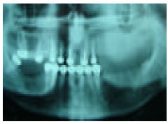 Image for - Overdenture Applications: Two Cases Reports