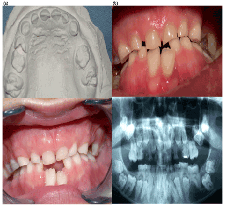 Image for - Full Retarded Eruption of Permanent Dentition: Report of a Rare Case (8 
  Years Follow-up)