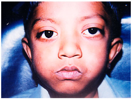 Image for - Crouzon Syndrome: A Case Report