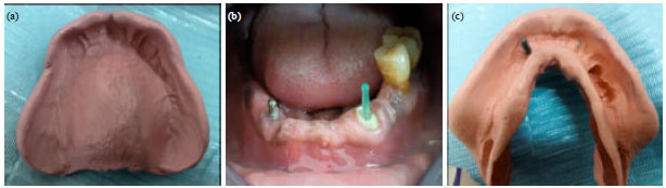 Image for - Duplicating the Implant O-ring Abutment Retainer for Using on Tooth Copy in Mandibular Implant-tooth Partial Overdenture: Radiographic Evaluations