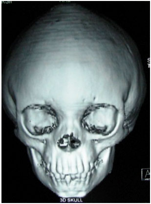 Image for - Crouzon Syndrome: A Case Report