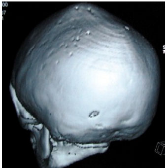 Image for - Crouzon Syndrome: A Case Report