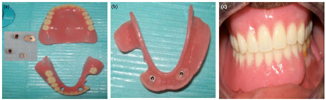 Image for - Duplicating the Implant O-ring Abutment Retainer for Using on Tooth Copy in Mandibular Implant-tooth Partial Overdenture: Radiographic Evaluations