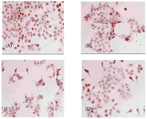 Image for - Expression of Cyclin D1 in Tamoxifen Resistant Subline of Human Breast Cancer T47D Cells