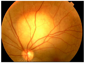 Image for - Choroidal Metastasis as First Manifestation Following Breast Conserving Surgery for Breast Cancer: Case Report