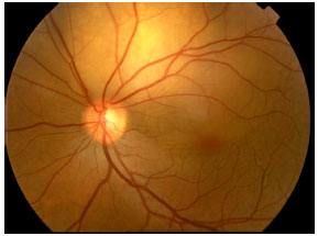 Image for - Choroidal Metastasis as First Manifestation Following Breast Conserving Surgery for Breast Cancer: Case Report