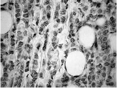 Image for - Immunohistological Localization of Human FAT1 (hFAT) Protein in 326 Breast Cancers. Does this Adhesion Molecule Have a Role in Pathogenesis?