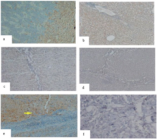 Image for - Differential Expression of uPA in Chronic Hepatitis B and C, Liver Cirrhosis and Hepatocellular Carcinoma: Comparison with Normal Liver Tissues and Liver Metastatic Tumors