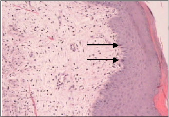 Image for - The Establishment and Use of an in vivo Animal Model for Cervical Intra-Epithelial Neoplasia