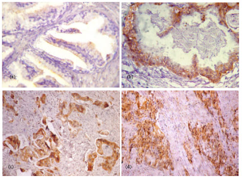 Image for - Expression of Macrophage Inhibitory Cytokine-1 in Benign and Malignant Prostatic Tissues: Implications for Prostate Carcinogenesis and Progression of Prostate Cancer