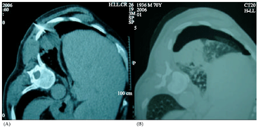 Image for - Study the Complications of Ct-guidance Fine Needle Biopsy in Intra-thoracic Masses