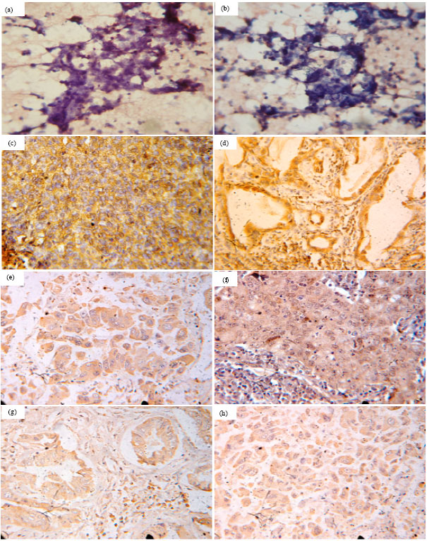 Image for - Significance of Immunohistochemical Expression of Fascin and Caveolin-1 in Non Small Cell Lung Cancer
