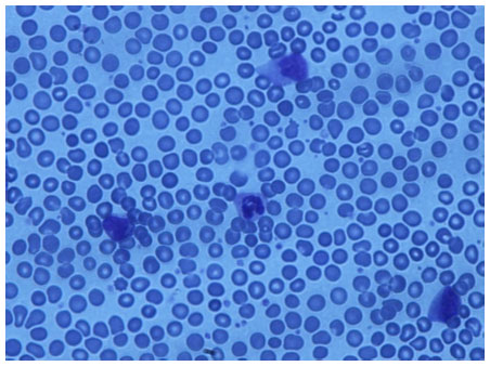 Image for - Chronic Myeloid Leukemia in Patient with Local Recurrence Colon Cancer: A Case Report