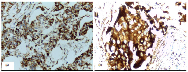 Image for - Nuclear and Cytoplasmic Expression of Survivin in Breast Carcinoma: Correlation with Clinicopathological Parameters