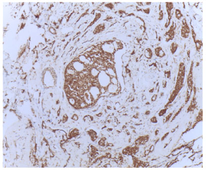 Image for - Expression of Vascular Endothelial Growth Factor Protein in Both Serum Samples and Excised Tumor Tissues of Breast Carcinoma Patients
