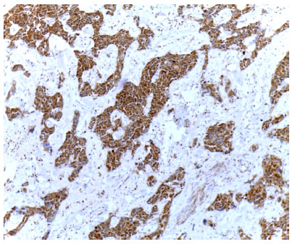 Image for - Expression of Vascular Endothelial Growth Factor Protein in Both Serum Samples and Excised Tumor Tissues of Breast Carcinoma Patients