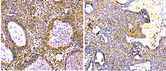 Image for - Immunohistochemical Analysis of Nf-κB Expression and its Relation to Apoptosis and Proliferation in Different Odontogenic Tumors
