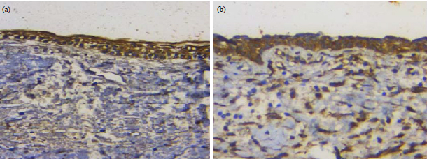 Image for - Immunohistochemical Analysis of Nf-κB Expression and its Relation to Apoptosis and Proliferation in Different Odontogenic Tumors