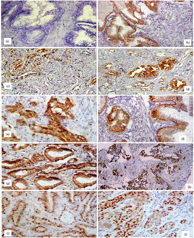 Image for - Clinical Significance and Potential Utility of Cancer Stem Cell Markers: ALDH1A1 and CD133 in Prostate Tumors