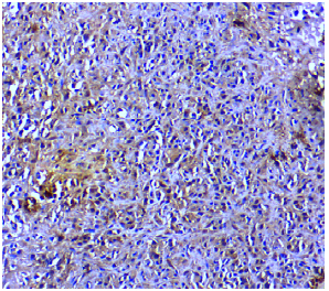 Image for - Expression of miR-34a/p53 and Their Apoptotic Target Bax in Oral Squamous Cell Carcinoma