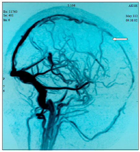 Image for - PEG Asparginase Induced Superior Sagittal Sinus Thrombosis with Status Epilepticus  Pediatric in Acute Lymphoblastic Leukemia (ALL): A Report of 2 Cases from India