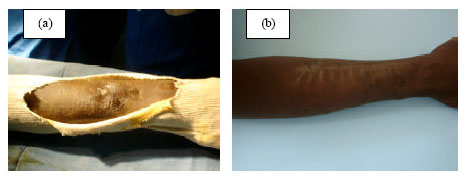 Image for - Preliminary Clinical Assessment of a Gentamicin-Loaded Monoolein Gel Intended to Treat Chronic Osteomyelitis