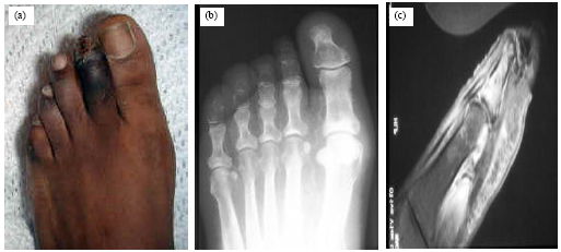 Image For - Different Procedures In Management Of Diabetic Foot Infections