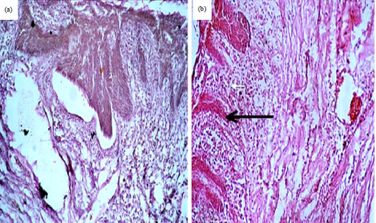 Image for - Histologic Evaluation of Furcation Perforation Treated with Mineral Trioxide Aggregate and Bioaggregate