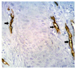 Image for - Evaluation of Therapeutic Effects of Aloe Vera: Coal Tar Mixture in Psoriasis: An Immunohistochemical Study