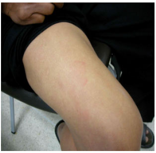 Image for - Chronic Urticaria at the Site of Healed Herpes Zoster: Wolf’s Isotopic Response