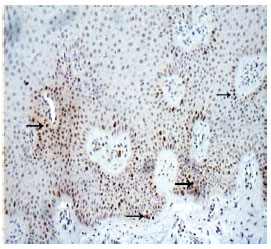 Image for - Evaluation of Therapeutic Effects of Aloe Vera: Coal Tar Mixture in Psoriasis: An Immunohistochemical Study