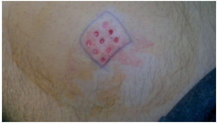 Image for - Repigmentation of Stable Vitiligo after Punch Minigrafting Followed by Excimer Laser: A Prospective Study