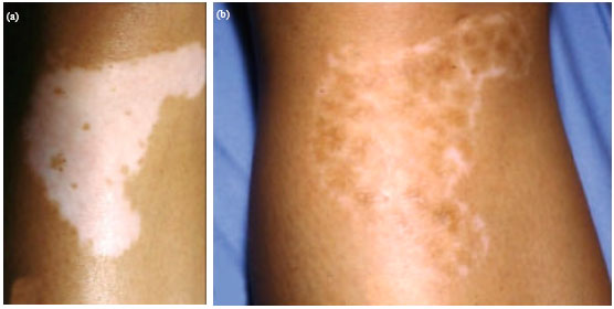 Image for - Repigmentation of Stable Vitiligo after Punch Minigrafting Followed by Excimer Laser: A Prospective Study