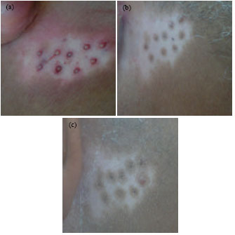 Image for - Combined Treatment of Post-burn Leucoderma with Autologous Minigrafting  and Topical Khellin-natural Sunlight among Egyptian Patients