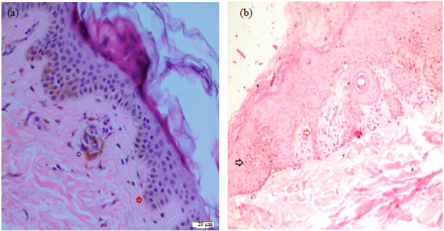 Image for - Case of Recurrent Type B Pigmentary Demarcation Lines in a Pregnant Woman