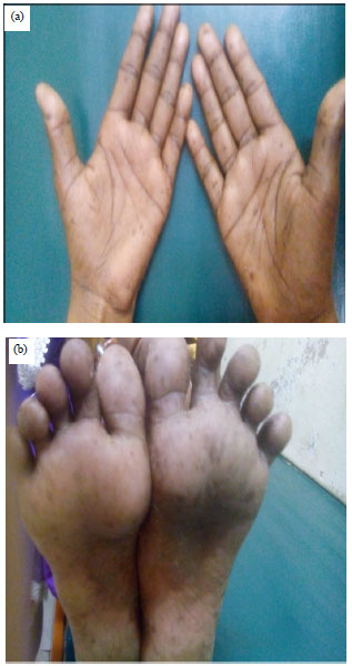 Image for - Peutz-jeghers Syndrome in a Child Presenting with Acute Abdomen: A Case Report
