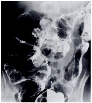 Image for - Peutz-jeghers Syndrome in a Child Presenting with Acute Abdomen: A Case Report