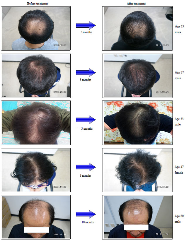 Image for - Effect of Natural Plant Extracts on Hair Loss Prevent in People with Alopecia