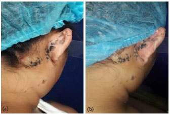 Image for - A Combined Approach to the Treatment of Nevus Comedonicus using Topical Adapalene and Oral Doxycycline
