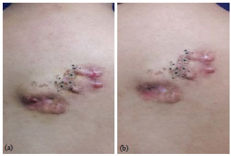 Image for - A Combined Approach to the Treatment of Nevus Comedonicus using Topical Adapalene and Oral Doxycycline